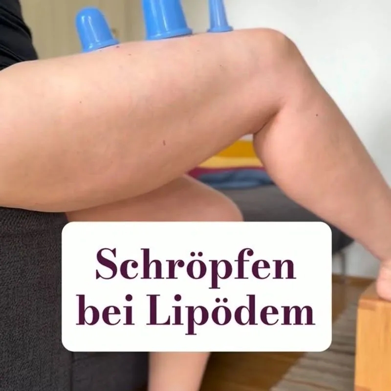 Instagram-Beitrag von @happy.lipo: Schröpfen löst die Faszien, fördert die Durchblutung und das kann prinzipiell…
